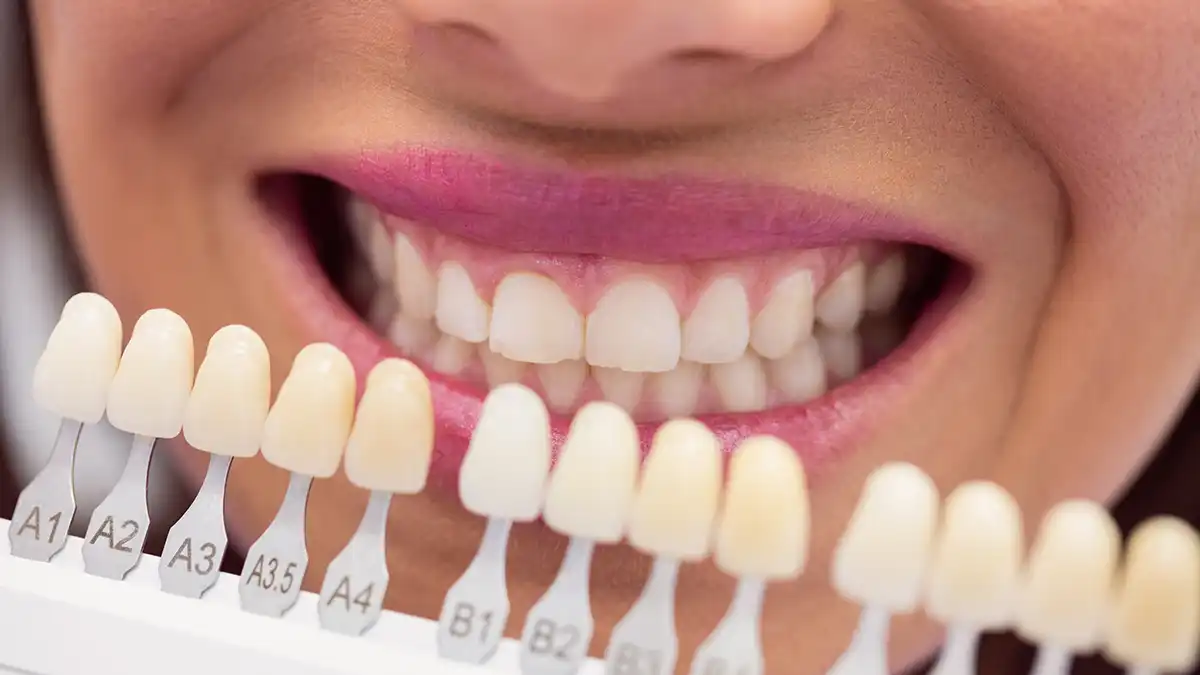 sbiancamento denti clinica san martino lecco